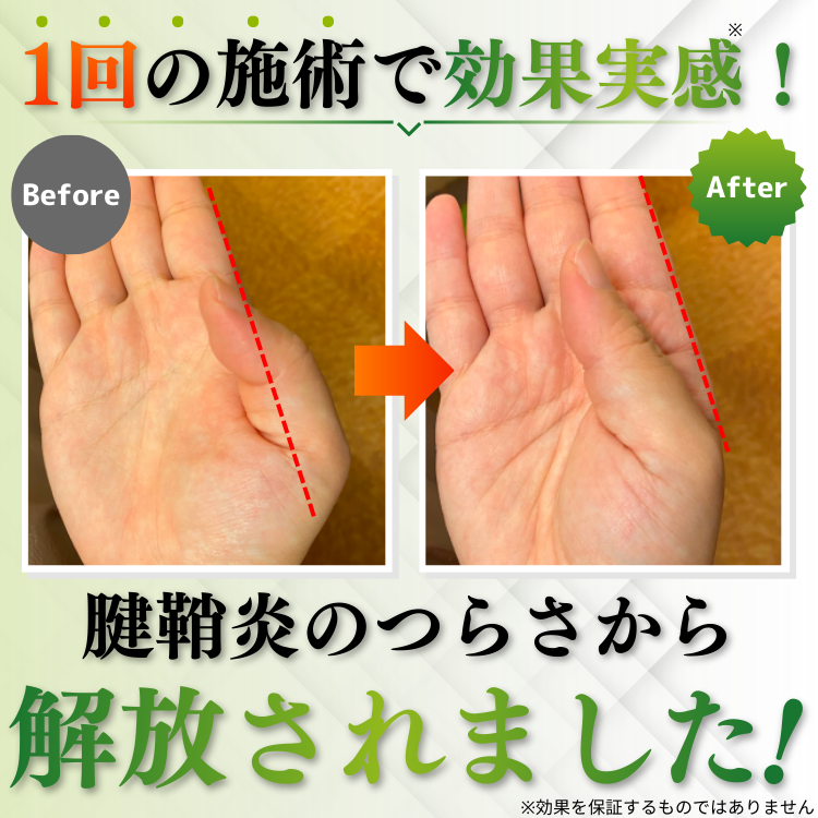 腱鞘炎ビフォーアフター